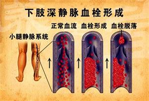 下肢深静脉血栓形成的病因分析