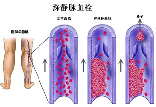 静脉血栓形成的原因