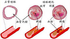 动脉硬化闭塞症是什么样的病