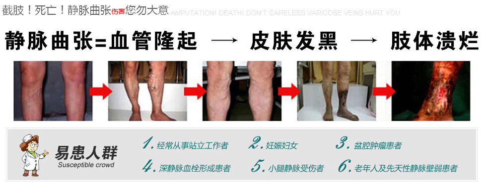 健康快报：五大常识问题 教你认清下肢静脉曲张