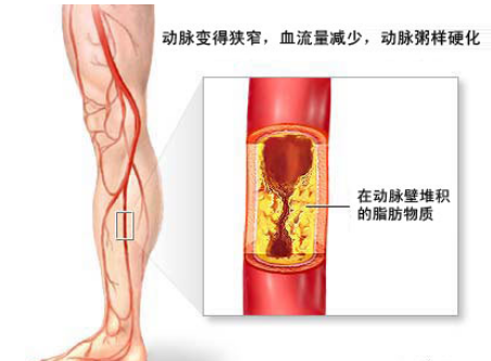 动脉硬化最突出的症状表现有哪些？