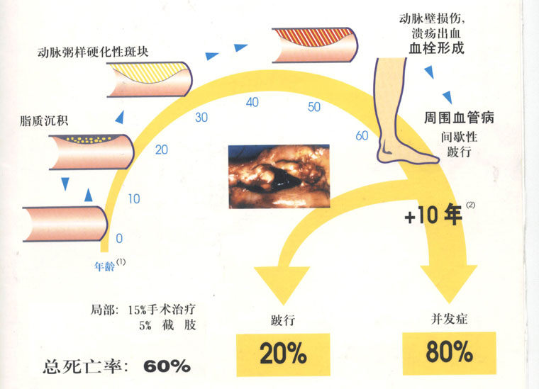 动脉硬化病理知识大汇总