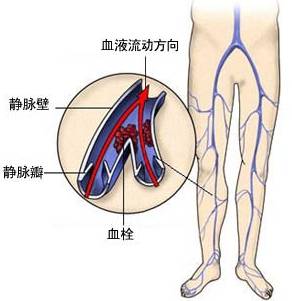 上班族久坐莫被“深静脉血栓”缠上