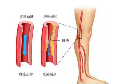 危险信号！动脉硬化阶段分期症状表现