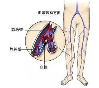 深静脉血栓是怎么产生的呢？