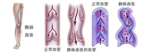 静脉曲张是怎么引起的呢