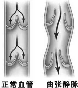 经常活动可以预防静脉曲张？