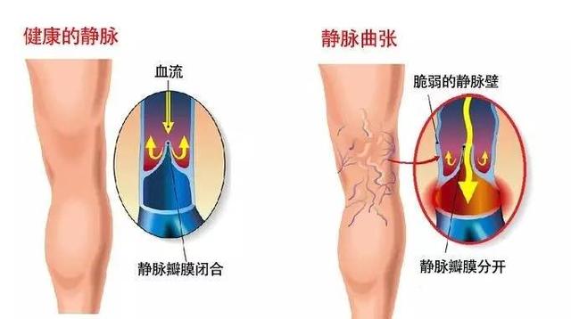 脚筋疼是怎么回事