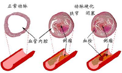 动脉粥样硬化的原因